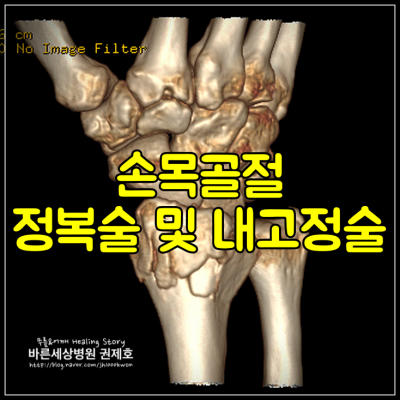 손목골절 : 개방적 정복술 및 내고정술