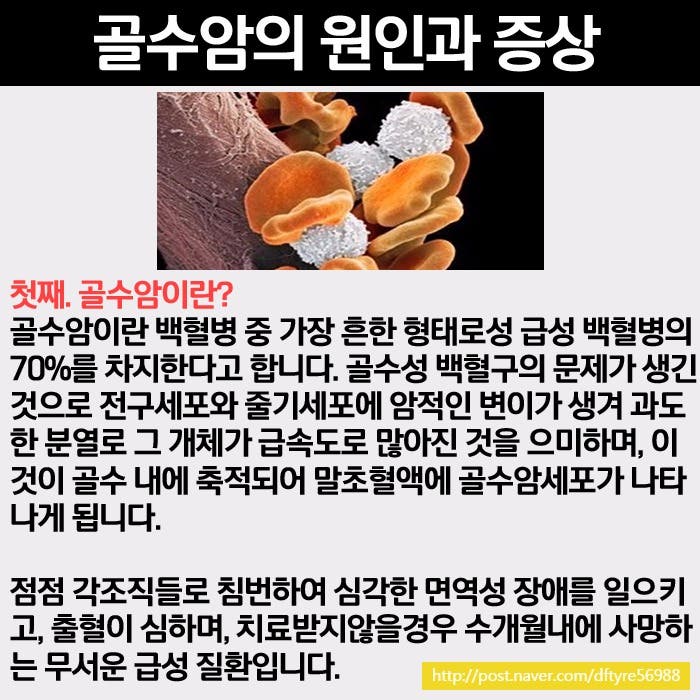골수암 골수에서 생기는 형질세포의 암