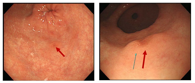 미란성 위염 때문에 포함되어 있습니다.