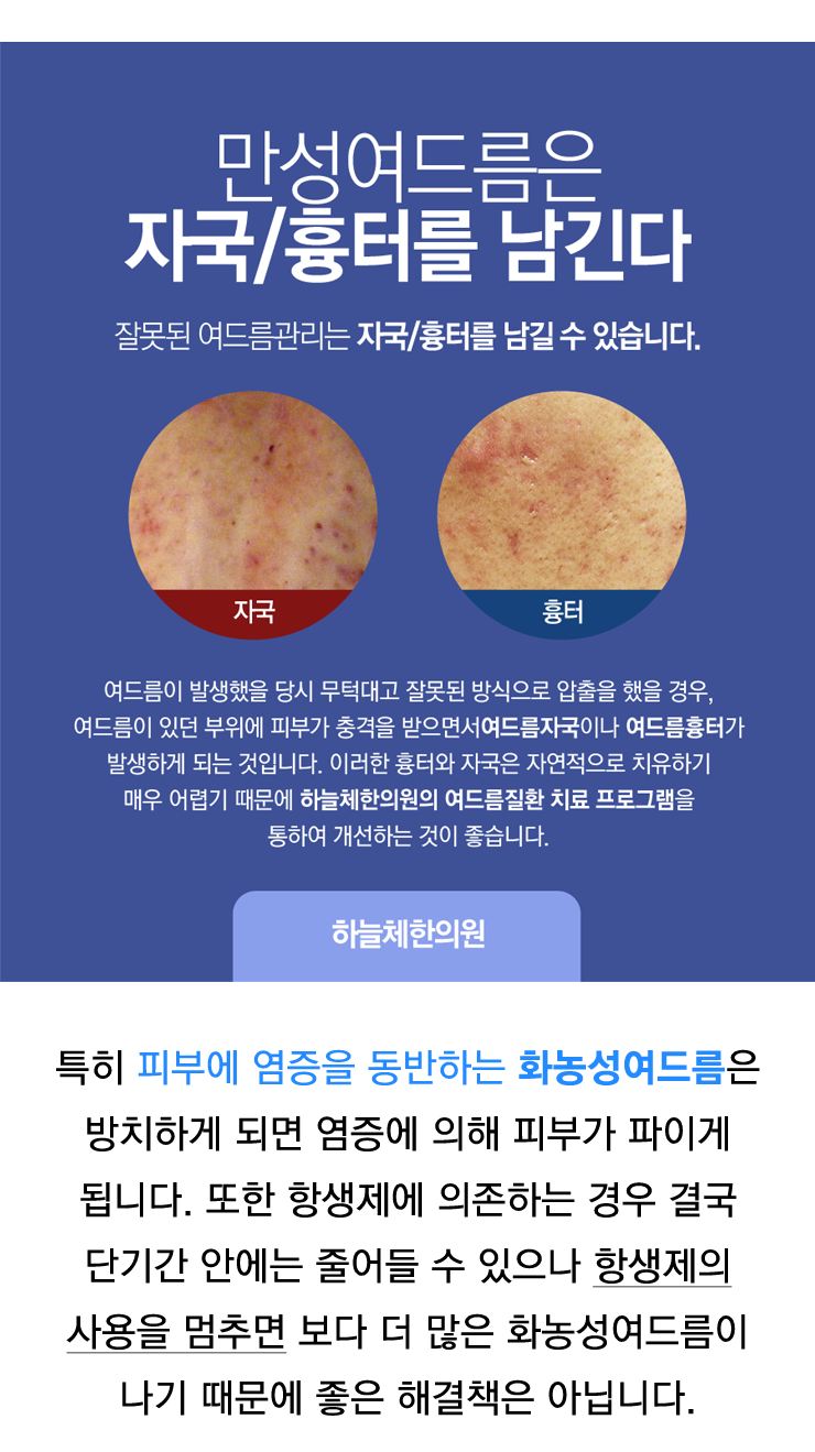 결절성여드름 만만하지않아요 : 네이버 포스트