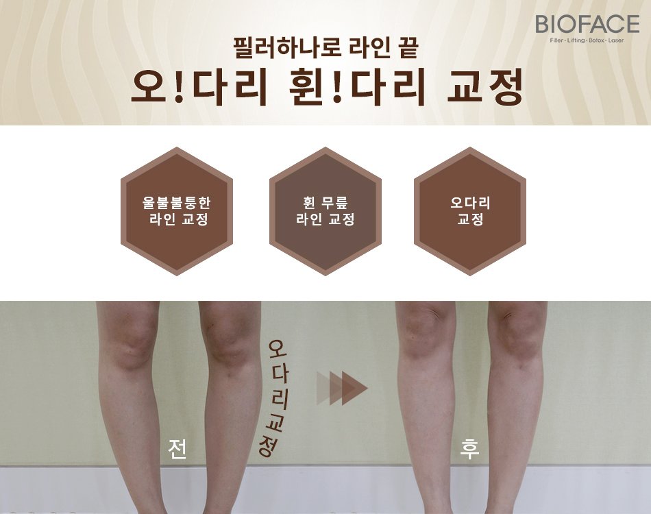 다리교정비용 휜다리, 필러로 효과볼수