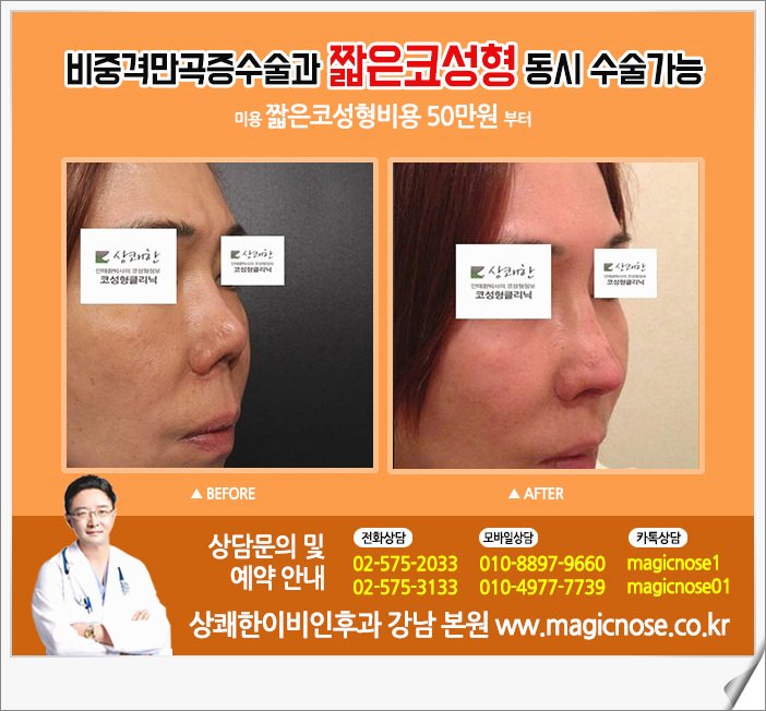 코성형 비용을 줄여보세요.