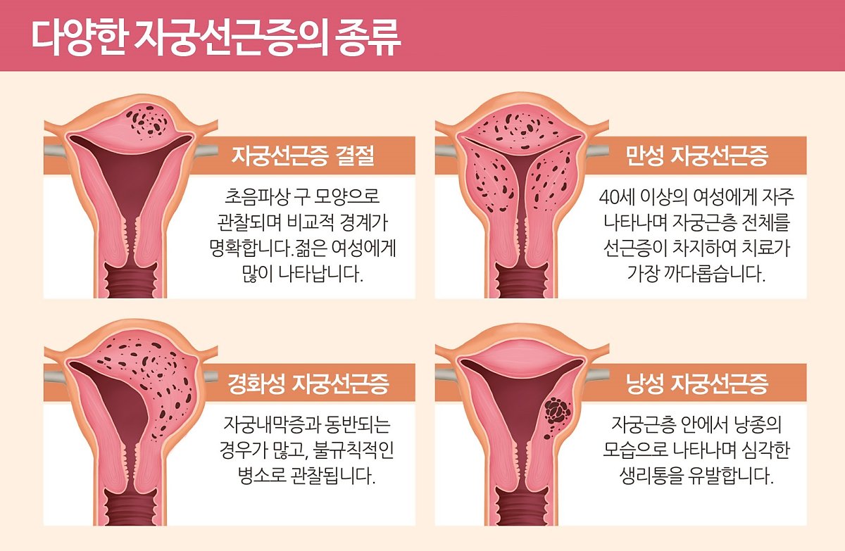 자궁선근증 임신 증상을 확인합니다.