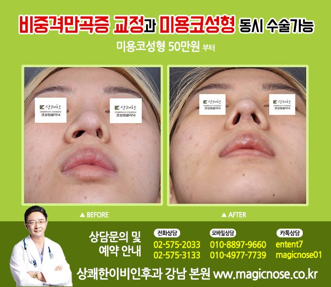 비중격 수술 비용