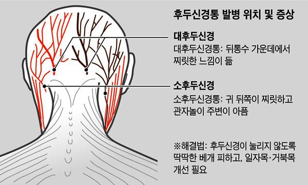 이마 두통은 축농증, 머리 전체 두통은 뇌출혈... 두통 부위별 의심 질환 : 네이버 포스트
