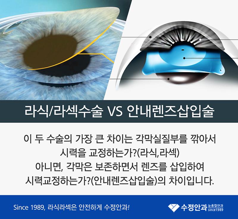 부산 라식, 라섹수술 Vs 안내렌즈삽입술 차이점! : 네이버 포스트