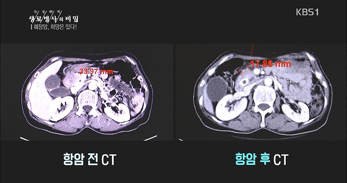 췌장암 이길수 있다