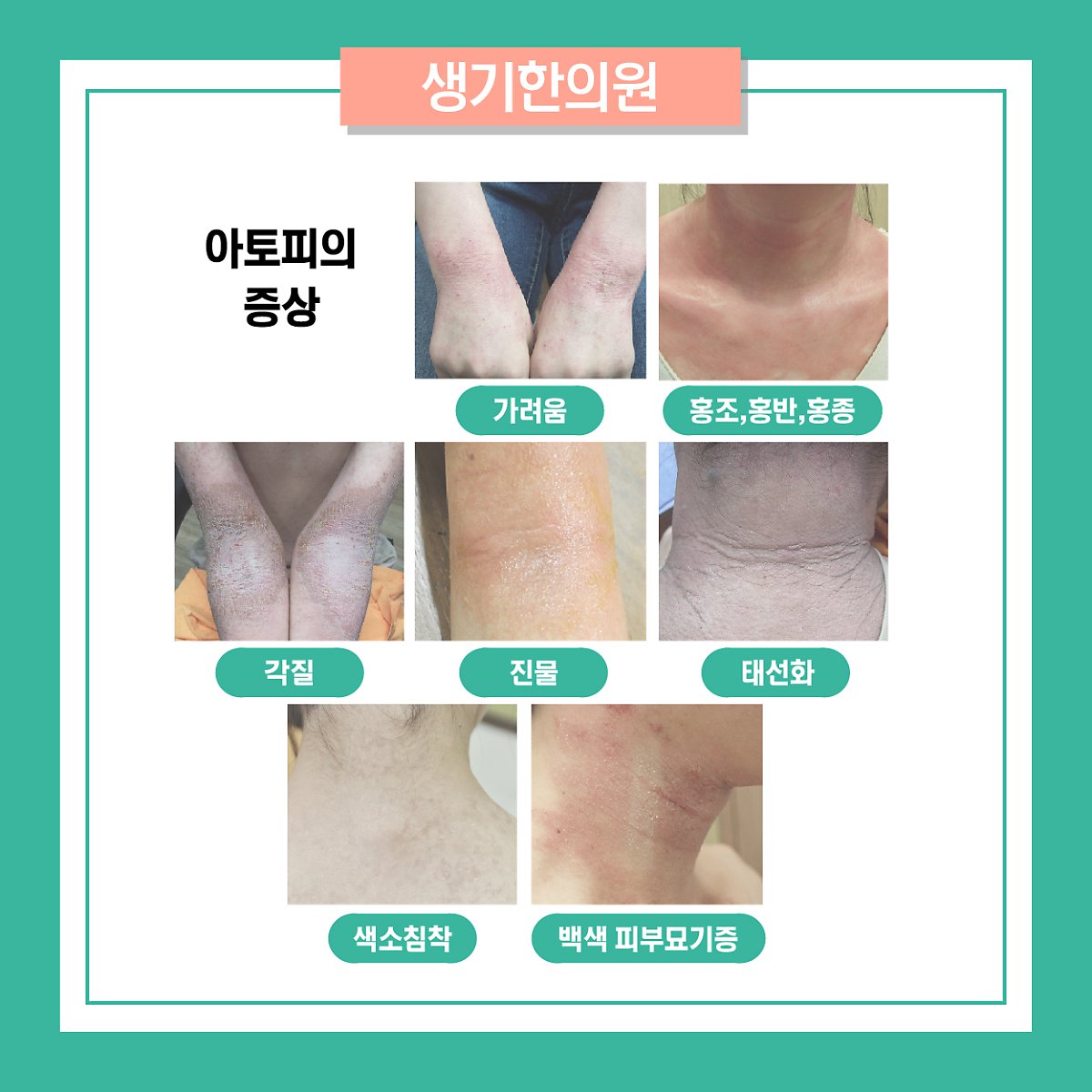 창원 아토피 피부염의 다양한 원인과 치료 : 네이버 포스트