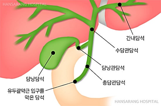 오른쪽옆구리통증 요로결석 담석증 증상 의심부터 네이버 포스트