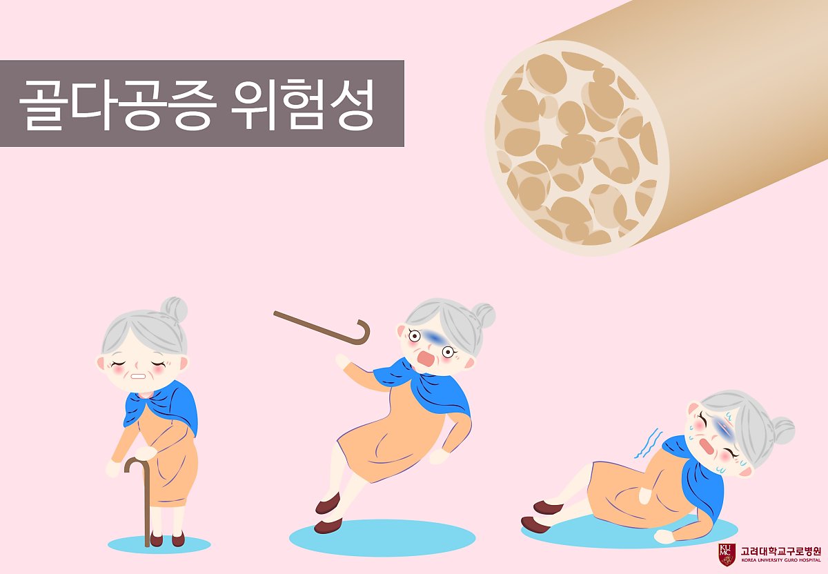 뼈도둑 골다공증, 방치하면 사망까지 : 네이버 포스트