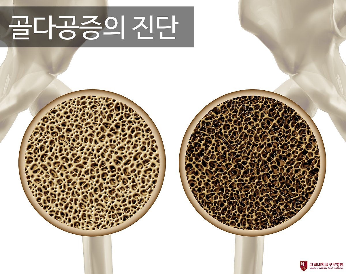 뼈도둑 골다공증, 방치하면 사망까지 : 네이버 포스트