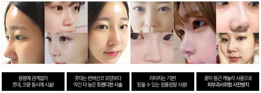 범계성형외과 자연스러운 대세 코필러 유지기간 7