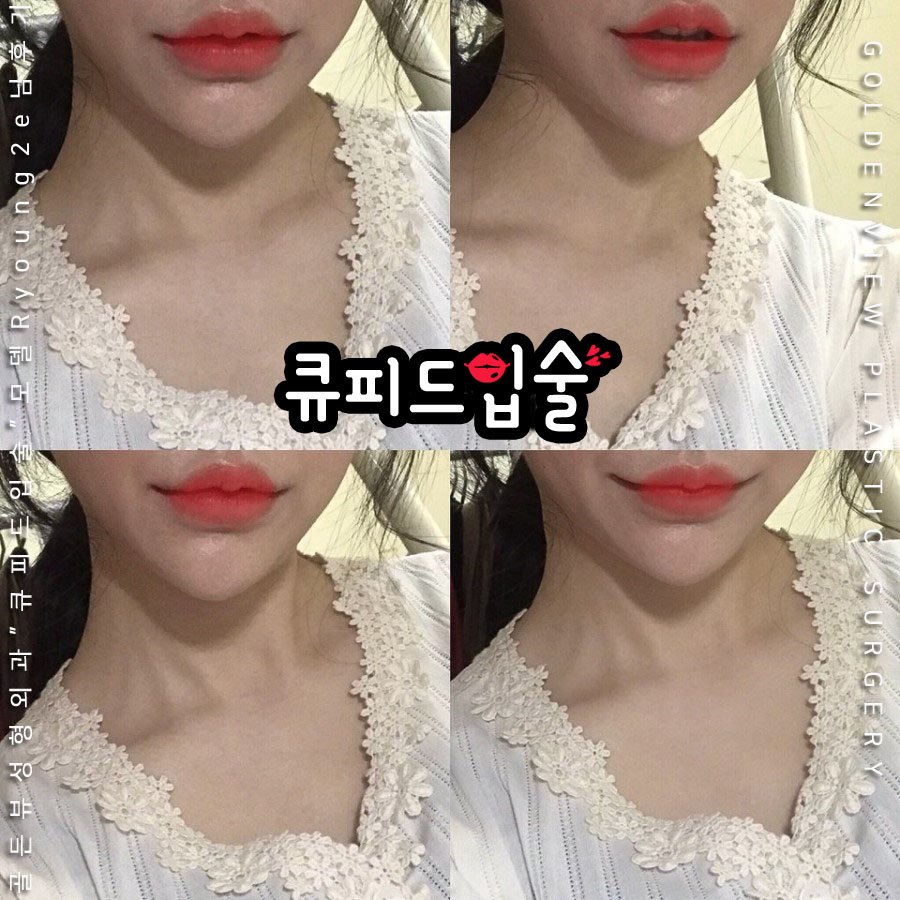 입술필러잘하는곳 골든뷰성형외과 큐피트입술 : 네이버 포스트