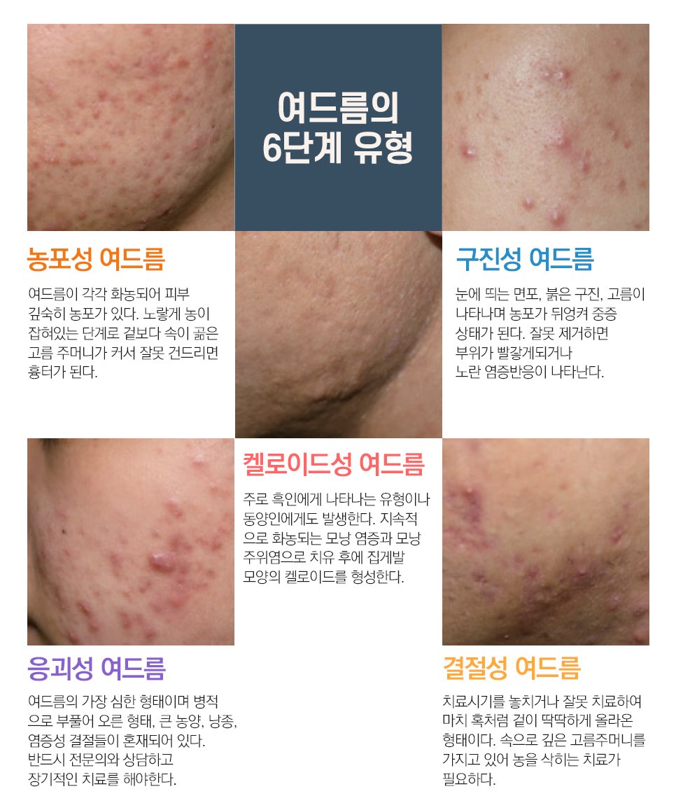 울산여드름피부과 한의원에서 치료하는 단계에 대해 : 네이버 포스트