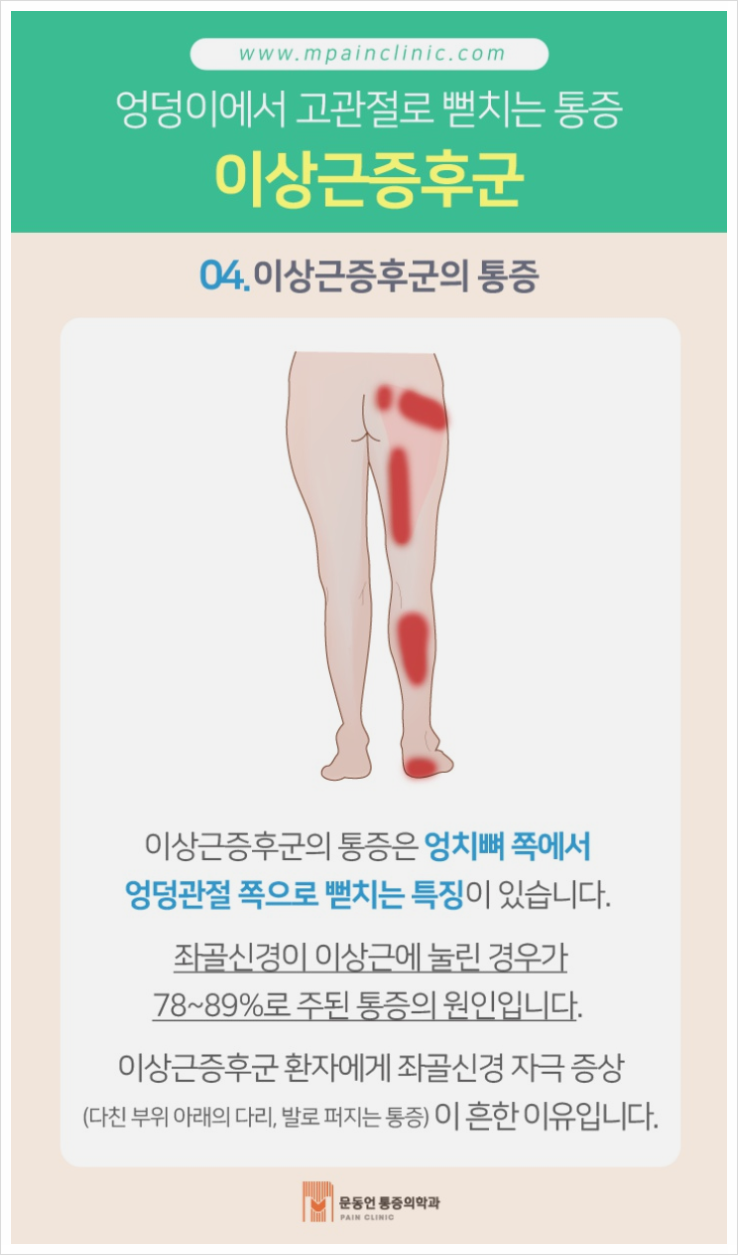 반포 엉덩이통증 좌골신경통 증상 및 완화법 6