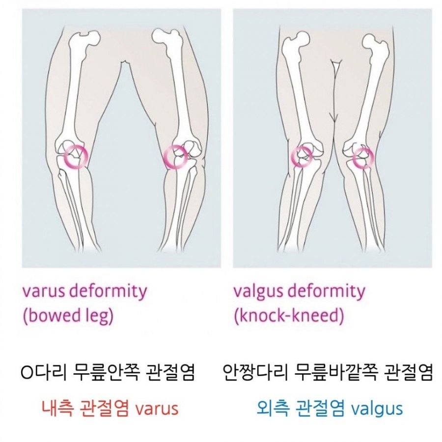 50,60대 퇴행성무릎관절염 주의 : 네이버 포스트