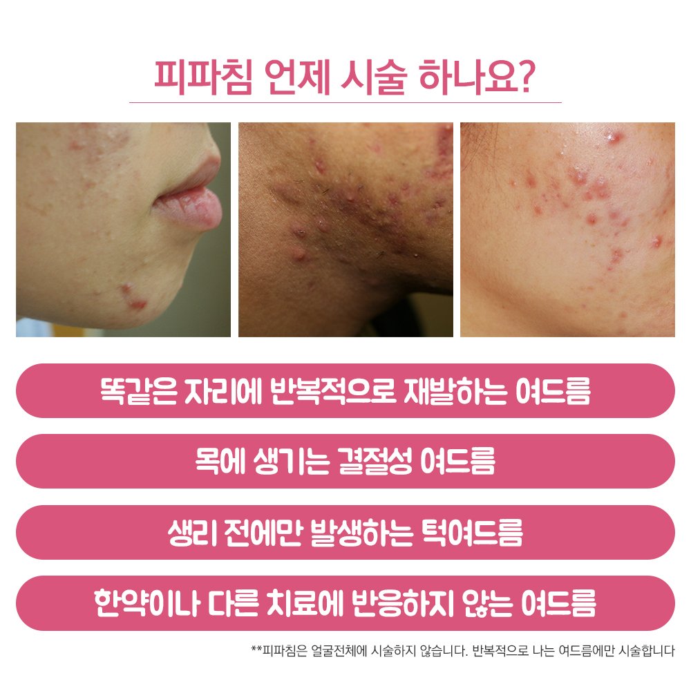 천안여드름피부과 한의원 치료 시 한약은 필수라고? : 네이버 포스트