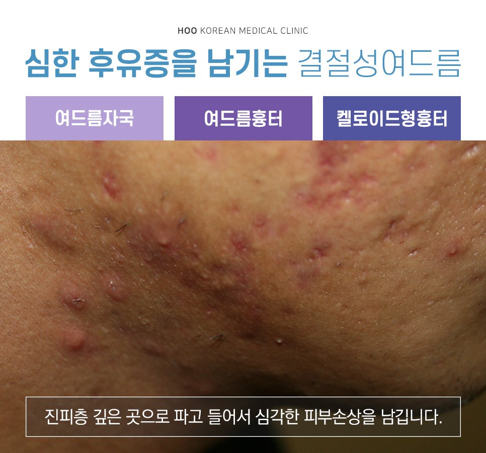 강남여드름한의원 치료 턱여드름에 효과가 좋은 것 : 네이버 포스트