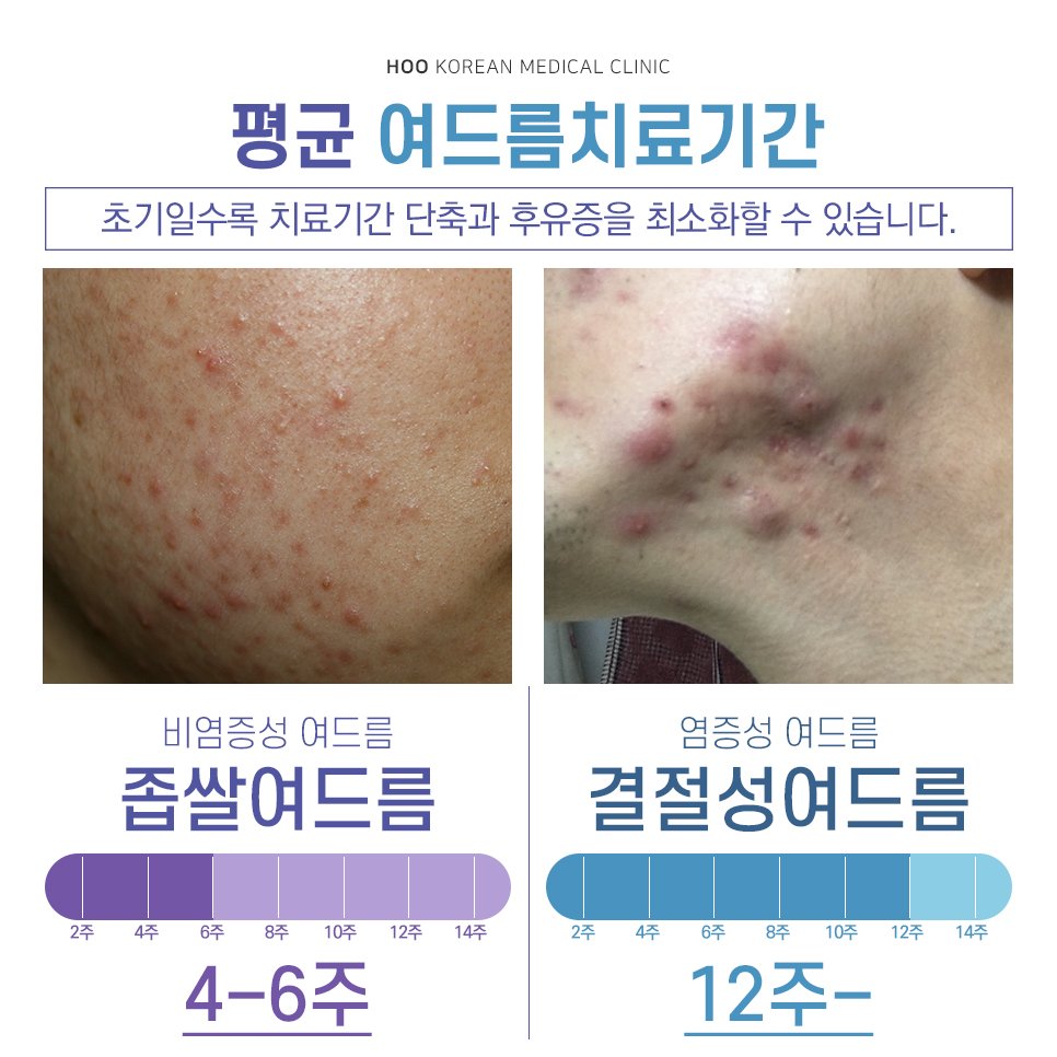 강남여드름한의원 치료 턱여드름에 효과가 좋은 것 : 네이버 포스트