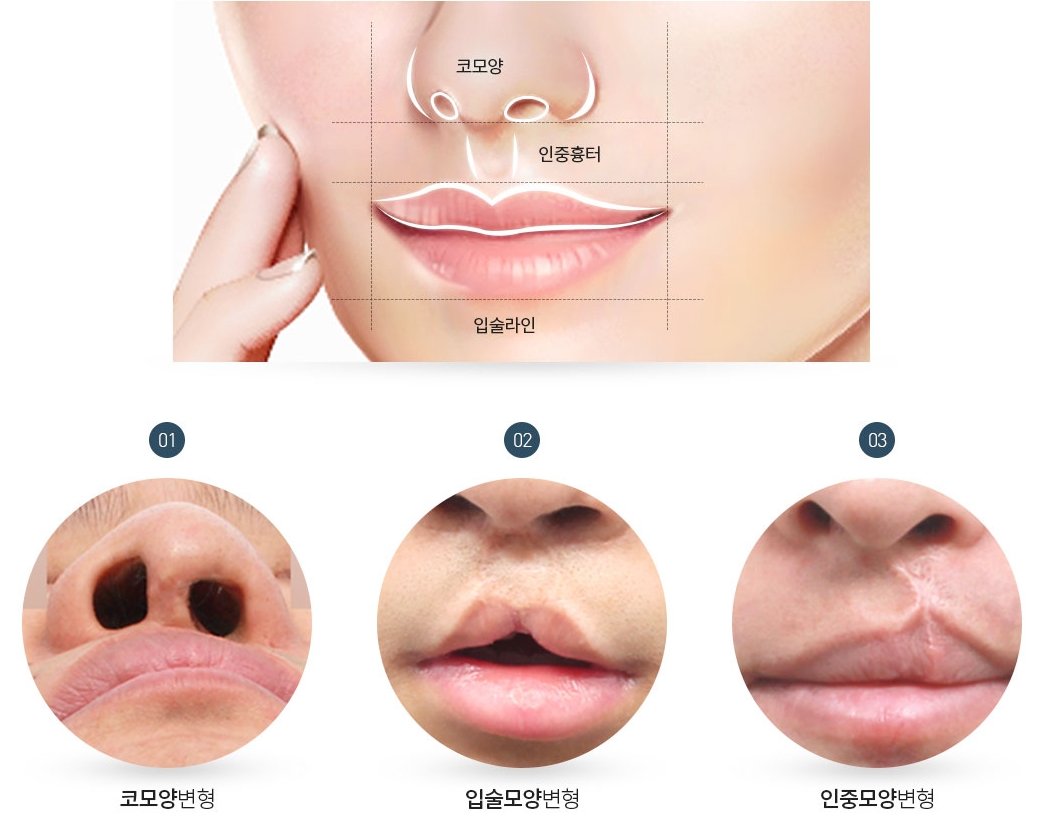 언청이수술 _구순구개열수술 어떻게 진행되나? : 네이버 포스트