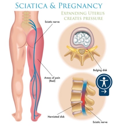 반포 엉덩이통증 좌골신경통 증상 및 완화법