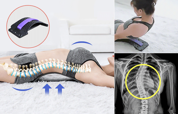 운동을 좋아하는 헬스녀도 선택한 힙 딥 필러 효과_운동으로는 해결할 수 없는 골반 옆으로 갈라짐. 5