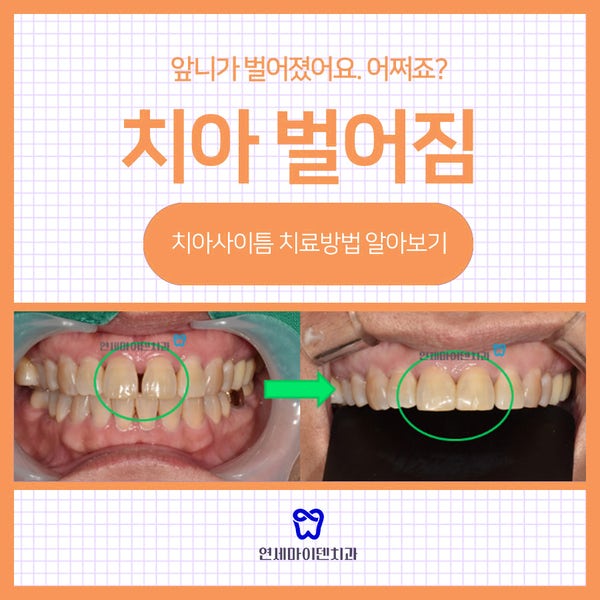 그것은 당신의 치아 사이에 떠 있습니다! 빠진 앞니 개선 (석촌역치과병원)
