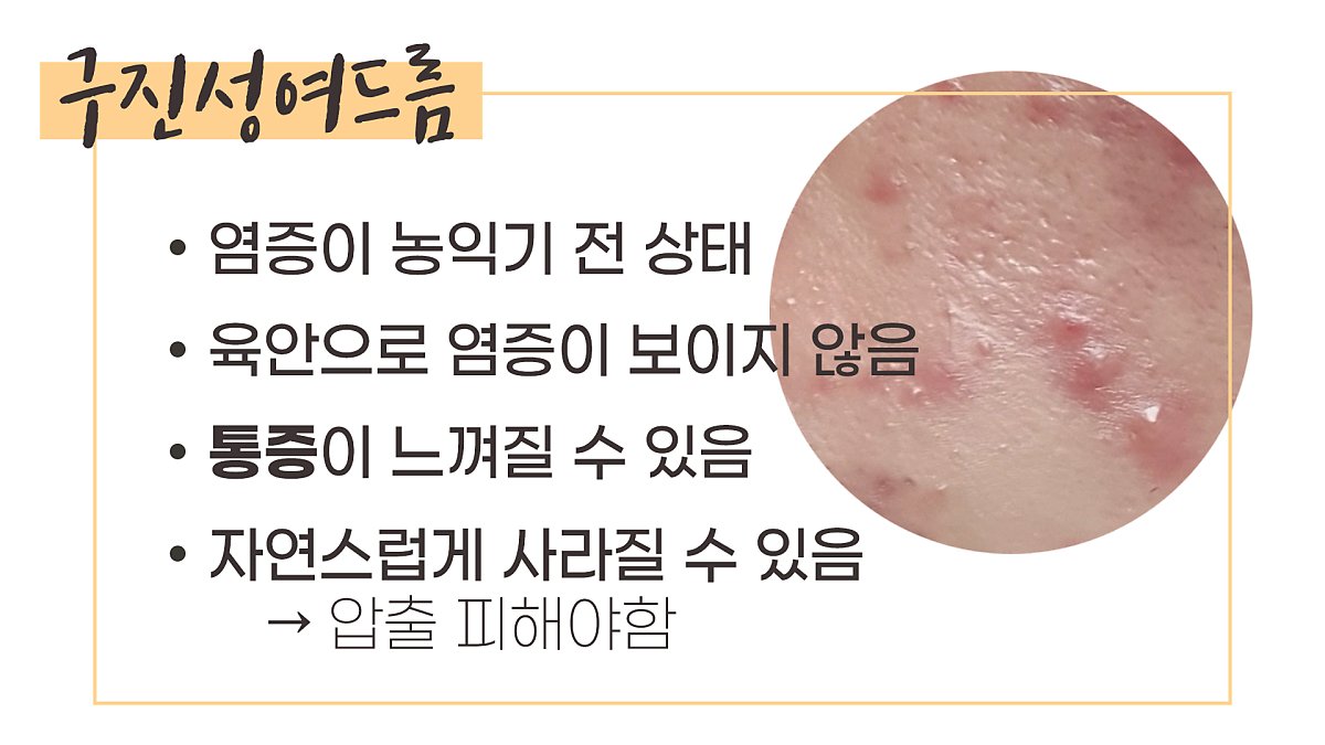 염증성여드름 비염증성여드름 종류별 특징과 관리 방법 : 네이버 포스트