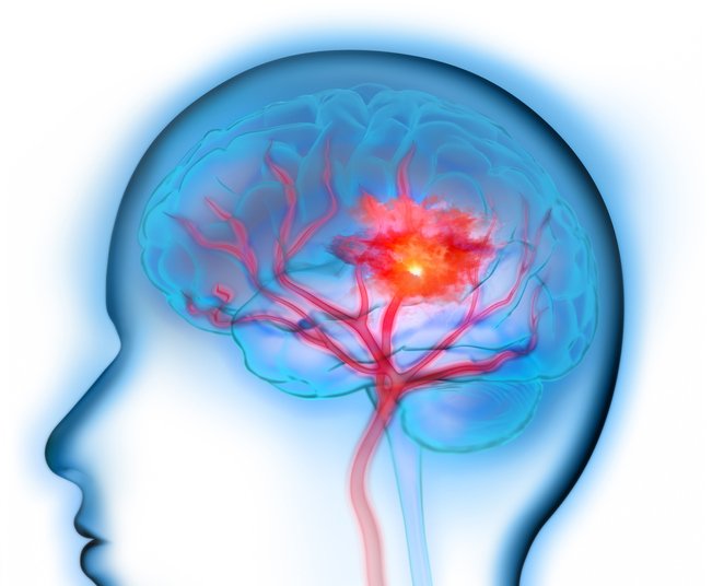 뇌졸중 예방에 도움 되는 습관 3가지