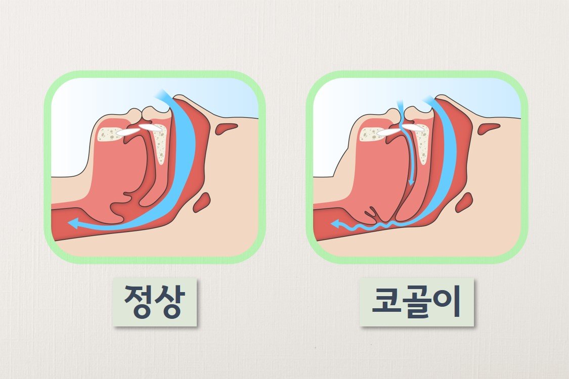 코골이 고치는법 확실하게 심한 원인