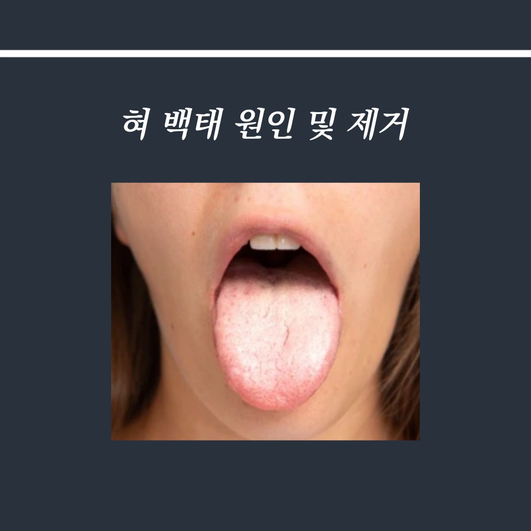 혀에 백태로 위장 건강을 체크할 수