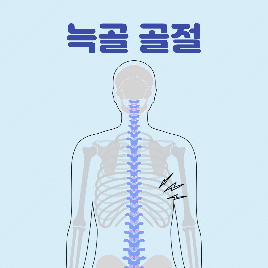 갈비뼈 금 갔을 때 증상, 치료, 늑골 골절에 좋은 음식 : 네이버 포스트
