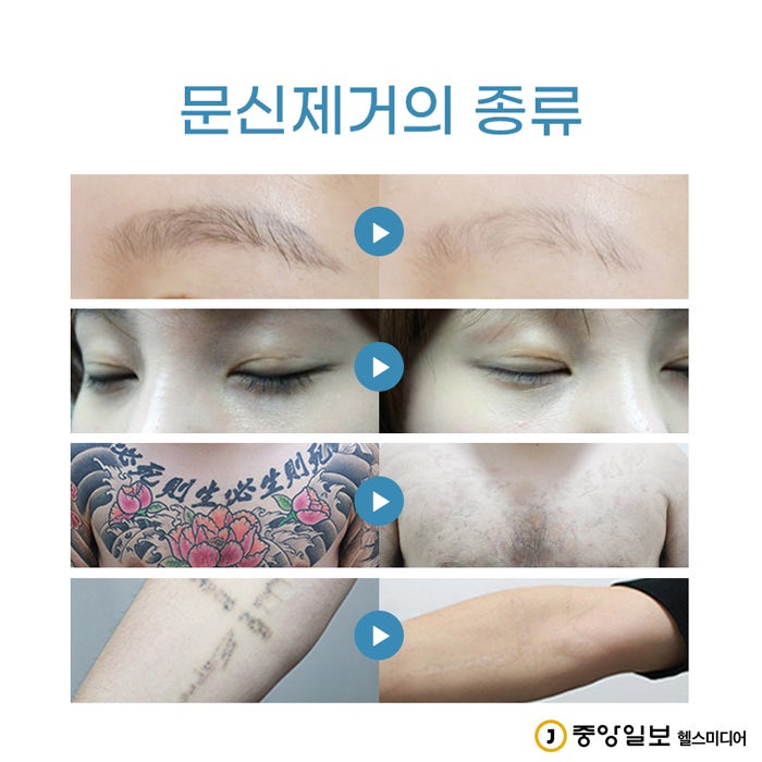 타투 지우는 장소 치료 보장제로 결과 만족도 up 10