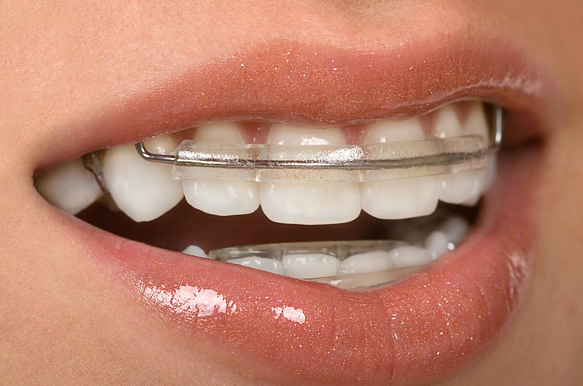 교정유지장치] 치아교정후 유지장치 꼭 필요할까? : 네이버 포스트