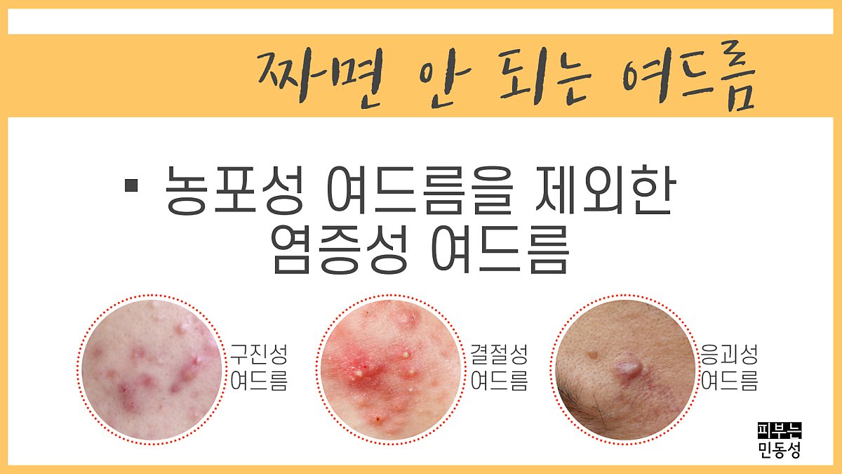 좁쌀여드름 염증성 여드름 압출 가능할까? : 네이버 포스트