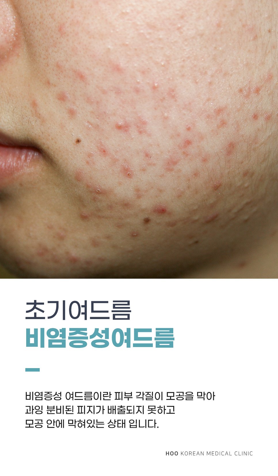 여드름한의원 여드름치료부터 흉터치료까지 : 네이버 포스트