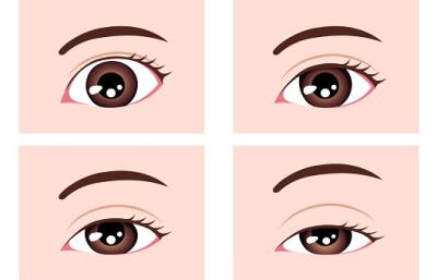눈매교정 수술 후 부작용 나타나면...풀어야 할까? : 네이버 포스트