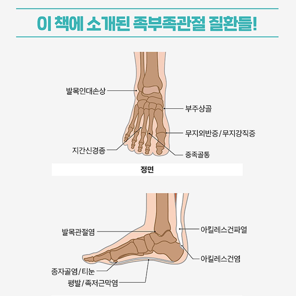 도촌동 정형외과 족부질환의 종류와 증상 및 예방법 6