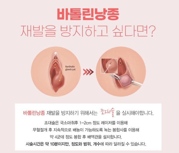 Bartholin의 낭포 회음부 발진은 증상을 유발합니다 외과 연고 예방 발.회음 부종