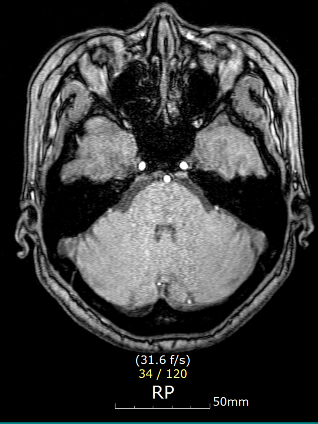 뇌 ct mri mra 검사 차이