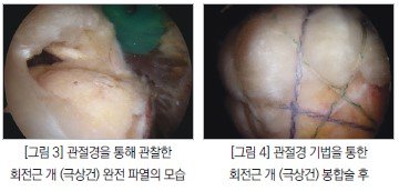 좌측 이미지 관절경을 통해 관찰한 회전근 개 완전 파열의 모습 / 우측 이미지 관절경 기법을 통한 회전근 개 봉합술 후 이미지