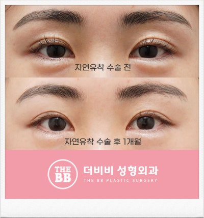 성형정보 인라인 쌍꺼풀 성형 윤곽선 장단점 쌍꺼풀 매몰법과 절개가격은? 5